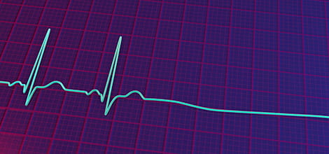 Illustration of ECG showing heartbeats and then flatline